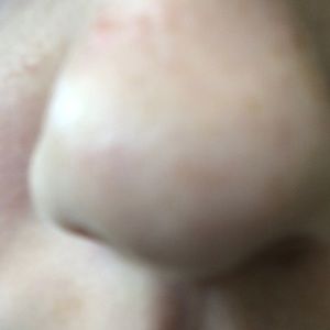 My hot nose